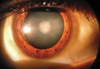 Photo of an eye with a cataract.