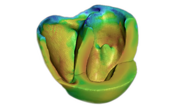Cardioid is the world’s most detailed simulation of the human heart in action and an example of high-performance computing applied to human health. The highly scalable code replicates the heart’s electrical system, depicting the activation of each heart muscle cell in near-real time and with accuracy and resolution previously unavailable.
