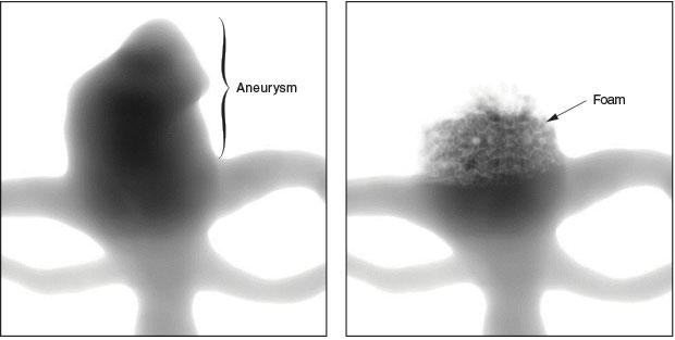 During an angiography procedure, a contrast agent is injected into the blood vessel and imaged using x rays to show how blood flows through the vessel. This virtual angiography simulation illustrates a patient-specific aneurysm before (left) and after (right) treatment with SMP foam. The foam reduces the flow (dark areas) and increases the blood residence time to promote clotting.